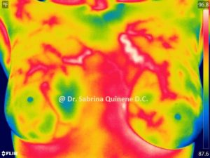 Breast Thermography Color